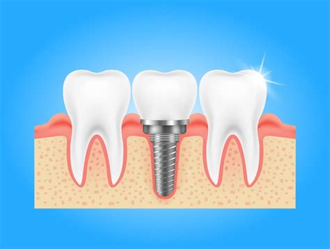 Tooth Implant Types