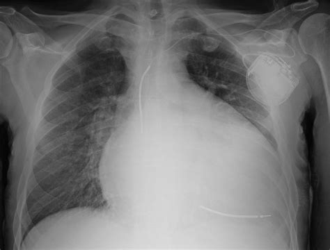 Alcoholic cardiomyopathy | BMJ Case Reports