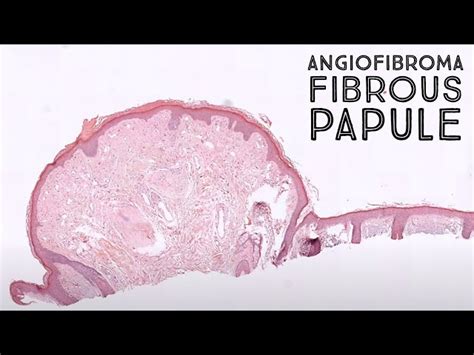 Fibrous Papule Histology