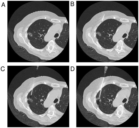 Lung Nodule Biopsy Procedure