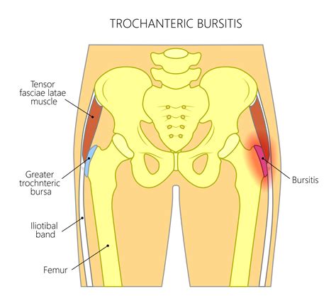 Trochanteric Bursitis: A Helpful Introduction & Overview | Dr. Andrachuk, Atlanta Orthopedist