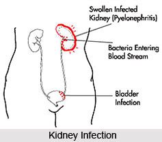 Urinary Disorders