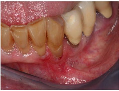 🎉 Erythroplakia. Oral Erythroplakia. 2019-01-09