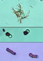 ‎Bilirubin crystals | eClinpath