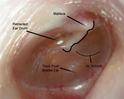 Fluid in the ear Images | McGovern Medical School