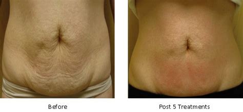 Velashape Before And After Abdomen