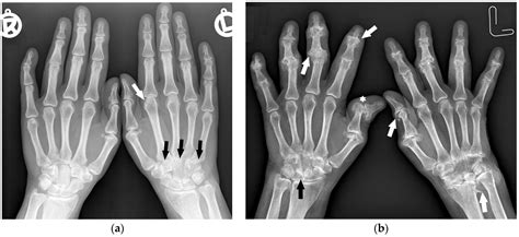 Osteoarthritis Vs Rheumatoid Arthritis Hands