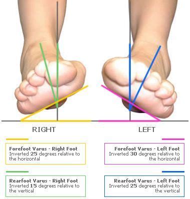 Foot shape assessment example shown identifies severe bilateral ...