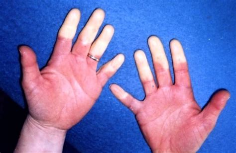 Physiotherapy Treatment in Burlington Raynaud’s Disease