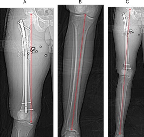 CT scanogram for limb length discrepancy in comminuted femoral shaft fractures following IM ...