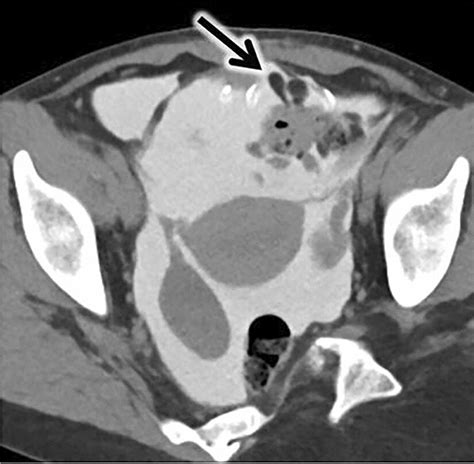 Epiploic appendages. Axial CT with intraperitoneal contrast outlines ...