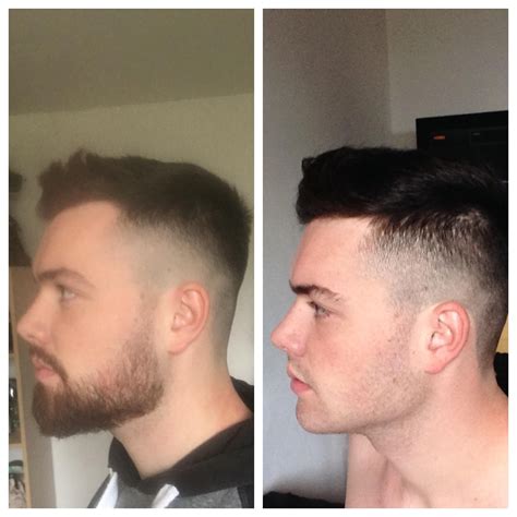 Minoxidil Beard Before And After Pictures | Beard Style Corner