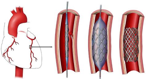 Stent Placement | Heart and Vascular Care | New Jersey