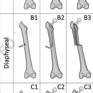 Periprosthetic Fracture Classification