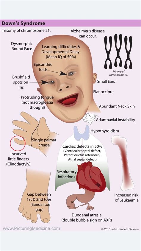 Down Syndrome Explained For Kids