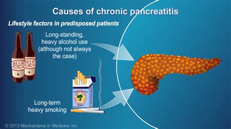 Slide Show - Management and Treatment of Chronic Pancreatitis