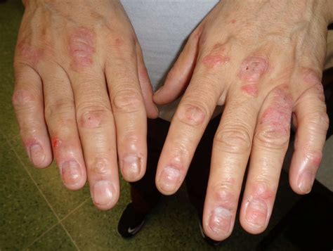 DermDx: Itchy Patches on the Hands - Dermatology Advisor