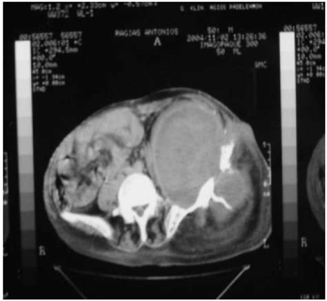 Massive septic pelvic osteolysis following revision total hip arthroplasty in a patient with ...