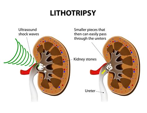 Shockwave Lithotripsy - AARE UROCARE - Female Urology | Urinary Incontinence Singapore