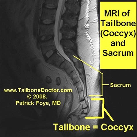 MRI of Tailbone, coccyx, sacrum, sagittal, for tailbone pa… | Flickr