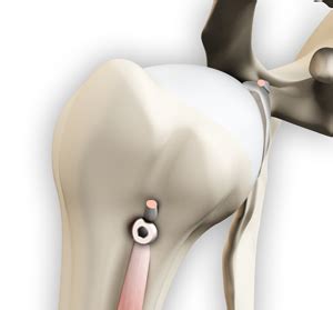 Proximal Biceps Tendon Rupture Wrexham | Proximal Biceps Repair Oswestry, UK