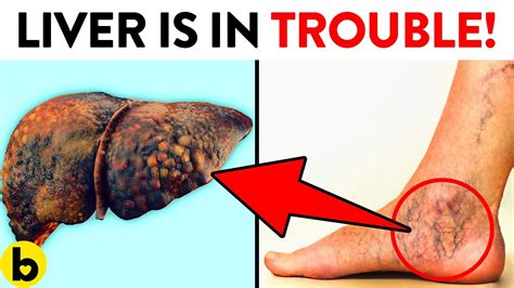 9 Ways Your Feet Are Telling You That Your Liver Is In Trouble - YouTube