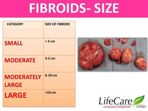 Low Dose Mifeprostone in the Management of Fibroid Dr Sharda Jain