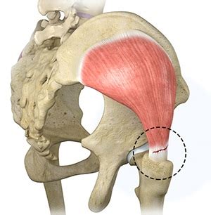 Gluteus Tendon Tear Dallas, TX | Hip Tendinitis Arlington, TX