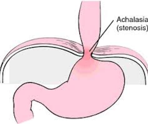 Achalasia Cardia - Signs and Symptoms, Diagnosis & Management