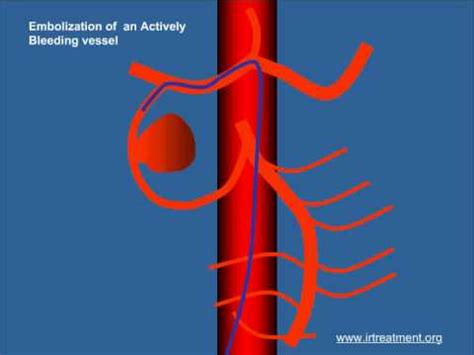 Embolization - YouTube