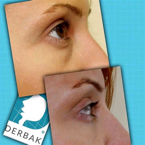 Laser Blepharoplasty Before And After (2) » Eyelid Surgery: Cost, Photos, Rewiews, Q&A