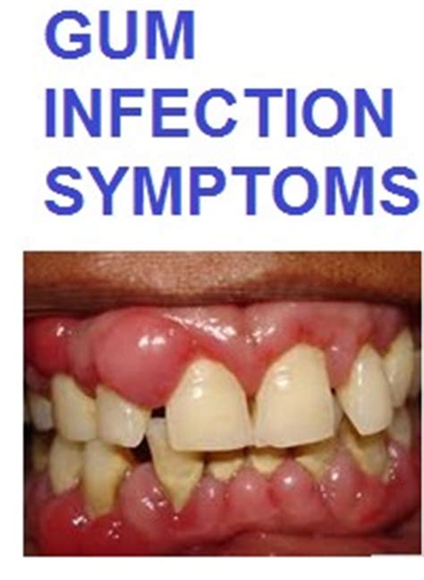 gum infection pictures Archives - Natural Health Advocates