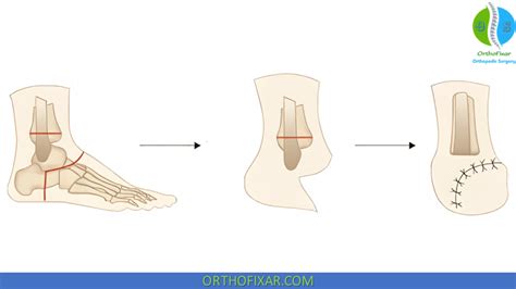 Syme Amputation & Prosthesis | OrthoFixar 2024