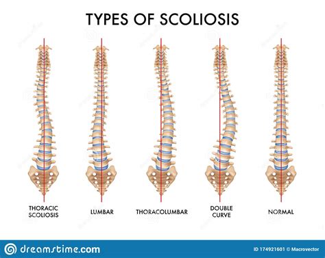 Scoliosis Degrees Of Curvature Chart, 57% OFF | mpi.gov.la