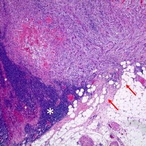 Representative example of a node with extracapsular spread. The arrows... | Download Scientific ...