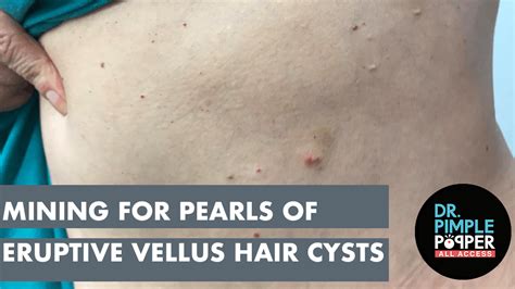 Mining for Pearls of Eruptive Vellus Hair Cysts - Dr. Pimple Popper