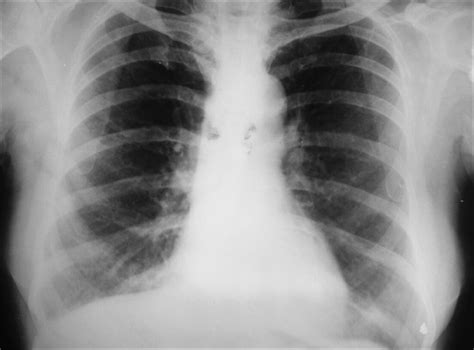 Hamman-rich Syndrome Symptoms, Causes, Diagnosis, Treatment