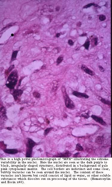 Malignant Fibrous Histiocytoma (MFH) - Pathology 40x | BoneTumor.org