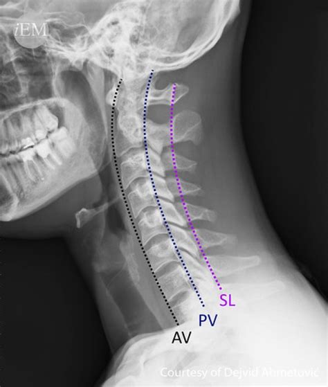 How to Read C-Spine X-Ray – International Emergency Medicine Education Project