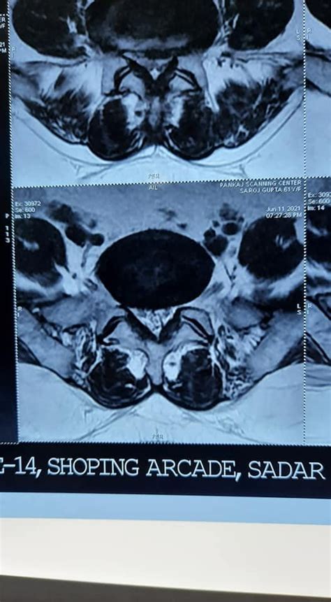 Minimally Invasive Spine Surgery in Multiple levels of Lumbar Slip disc and Lateral recess stenosis.