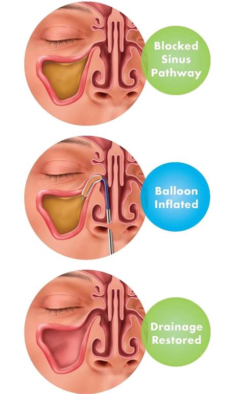 Balloon Sinus Dilation | Nasal Balloon | St. Louis Sinus Center