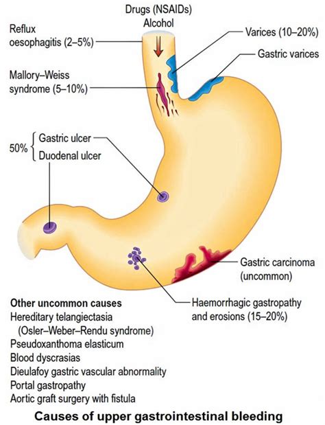 Melena stool definition, causes, symptoms, diagnosis & melena treatment