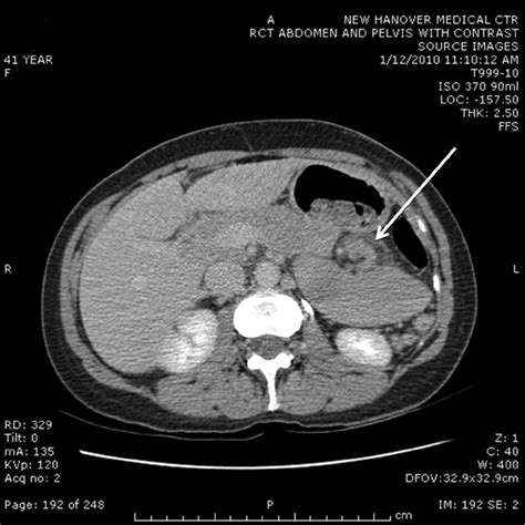 Axial view, CT scan of the abdomen. Note the nonanatomic position and ...