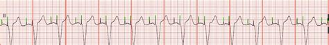 EKG Rhythm Strip Quiz 30