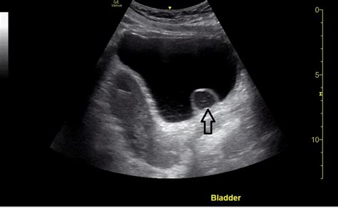 Cureus | Ureterocele Diagnosed With Point-of-Care Ultrasound