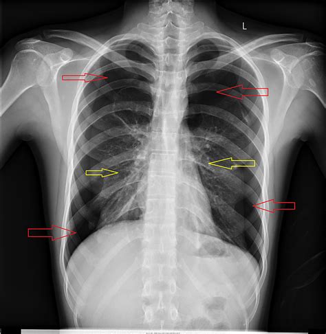 Cureus Simultaneous Bilateral Spontaneous Pneumothorax A Rare | The Best Porn Website