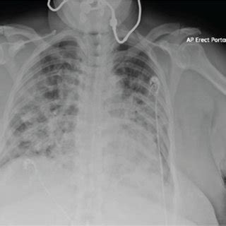 Chest X-ray: bilateral consolidations. | Download Scientific Diagram