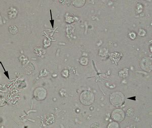 WBC and bacilli in unstained urine. | eClinpath