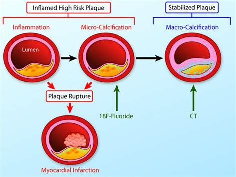 Imaging Cardiovascular Calcification | Journal of the American Heart ...