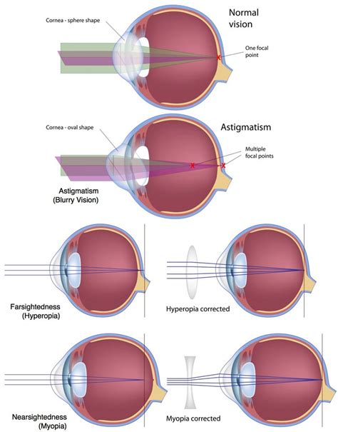 LASIK Eye Surgery for Vision Correction at Fort Worth Eye Associates